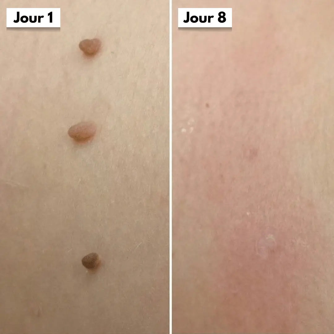 DermaSkin Pro™ - Adieu les acrochordons
