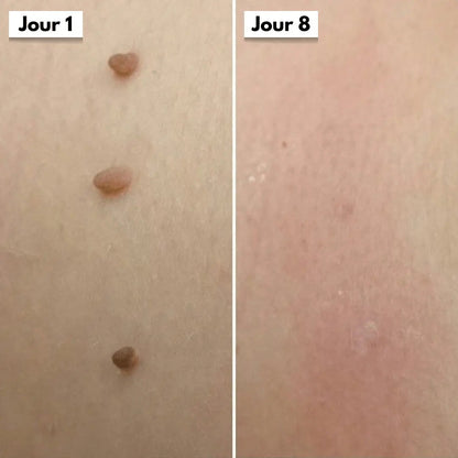 DermaSkin Pro™ - Adieu les acrochordons