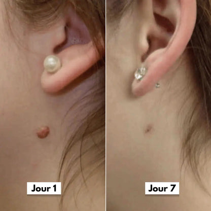 DermaSkin Pro™ - Adieu les acrochordons